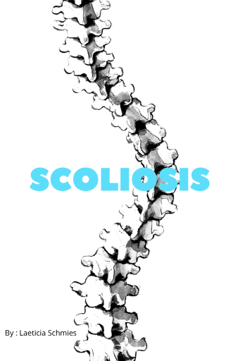 Scoliosis+